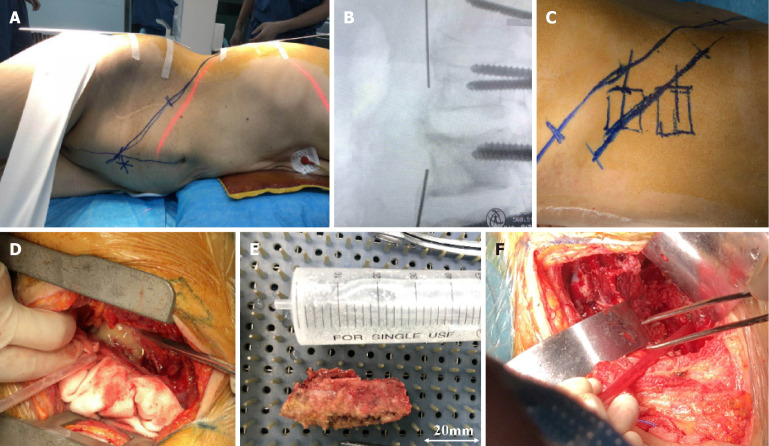 Treatment of lumbar tuberculosis with minimally invasive anterior lesion clearance combined with posterior fixation.