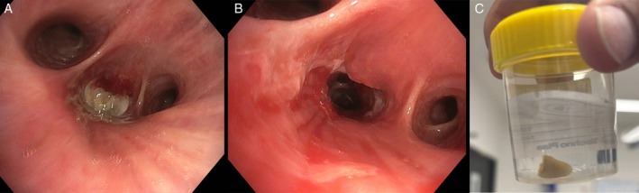 A Crumpet, a Canine and a Cryoprobe: A Case of Tooth Aspiration.