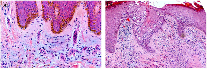 Development of a Cutaneous Horn on a Lower Extremity with Granuloma Annulare: A Rare Co-Occurrence.