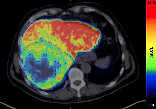 Evaluation of the effect of locoregional treatment on metabolic liver function in hepatocellular carcinoma using <sup>18</sup>F-FDGal PET/CT.