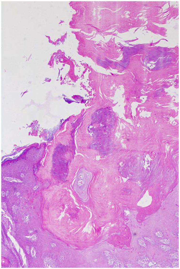 Development of a Cutaneous Horn on a Lower Extremity with Granuloma Annulare: A Rare Co-Occurrence.