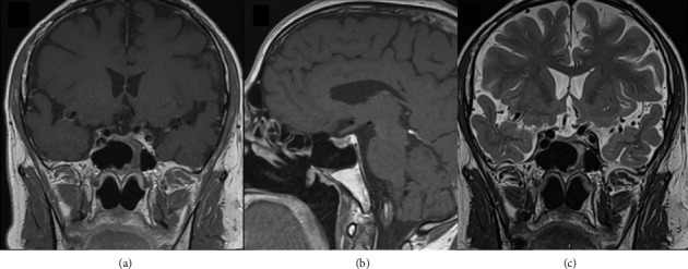 A Medical Rarity: Isolated <i>Toxoplasma gondii</i> Abscess in the Pituitary Gland of an Immunocompetent Patient.