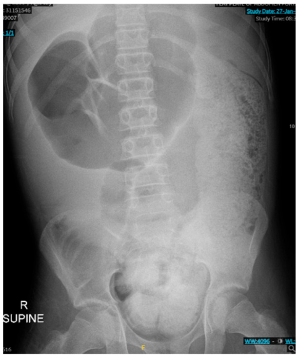 A Case Report of a Child with Constipation Diagnosed with Acquired Myenteric Hypoganglionosis.