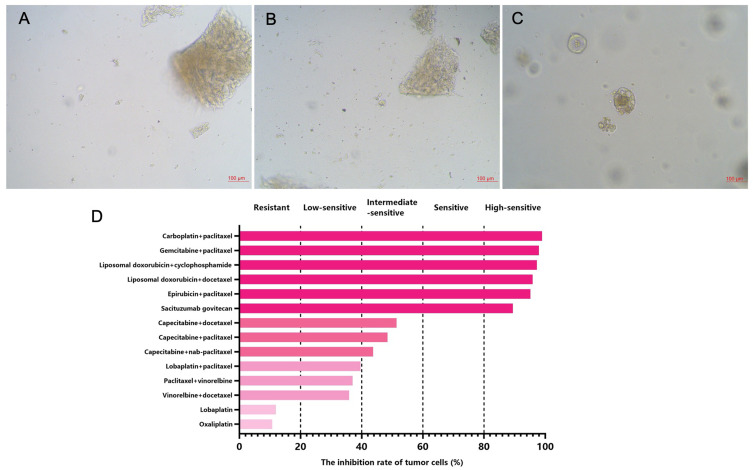 Partial Response Achieved in a Case of Metastatic Triple-Negative Breast Cancer Based on the Patient-Derived Tumor Organoids.