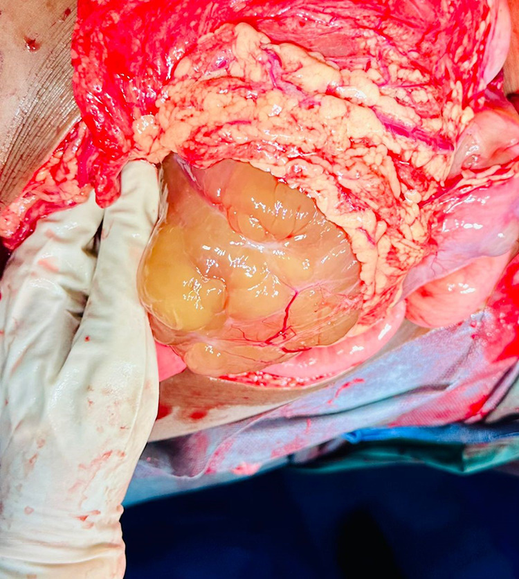 Ovarian Yolk Sac Tumor in a Young Girl in a Resource-Limited Setting: A Rare Case Report From Somalia.
