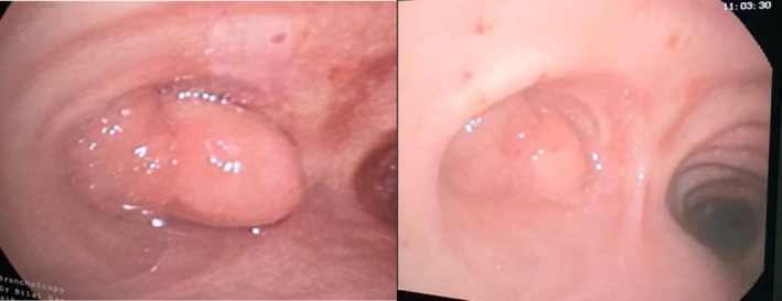 Endobronchial Lipoma: A Hidden Obstruction Behind Chronic Cough.