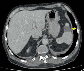 Synchronous Presentation of Nodular Melanoma and Epithelioid Cell Melanoma: Case Report.