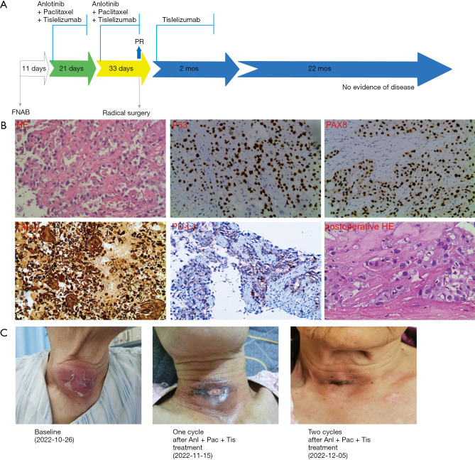 Neoadjuvant therapy and surgical resection successfully treating primary thyroid squamous cell carcinoma: a case report.