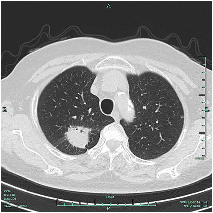 Clinical Value of Low-Dose Spiral CT Combined with Serum CEA in the Differential Diagnosis of Early Lung Cancer.
