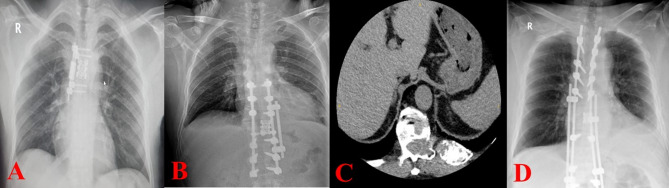 The role of thoracic surgeons in spinal surgery: our clinical experiences.
