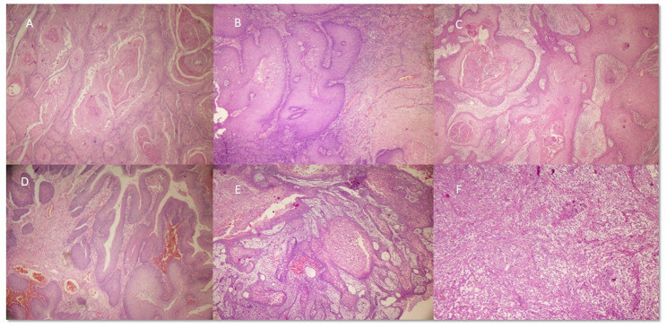 Clinicopathological features and reclassification of penile squamous cell carcinoma according to WHO classification 2022 for penile carcinoma with p16 immunohistochemical expression and its prognostic impact.