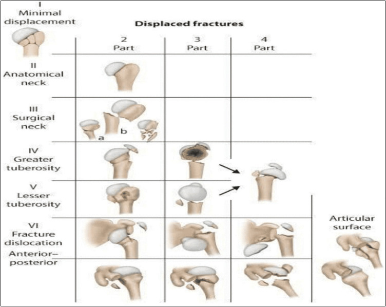 Assessment of Clinical and Functional Outcomes of the Proximal Humerus Internal Locking Compression Plate in Different Neer's Types of Proximal Humeral Fracture: A Prospective Observational Study.