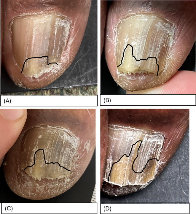 Efficacy of Topical Antifungal Nail Solution Versus Topical Placebo Solution for the Treatment of Pedal Onychomycosis: A Randomized Controlled Trial.
