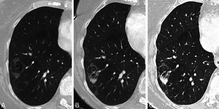 The TSANZ Practical Guide for Clinicians in the Management of Screen- and Incidentally-Detected Nodules.