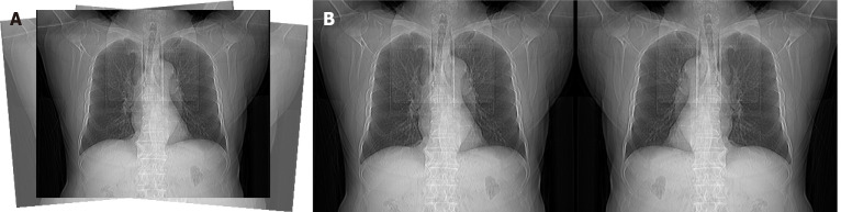 Determining the scanning range of coronary computed tomography angiography based on deep learning.