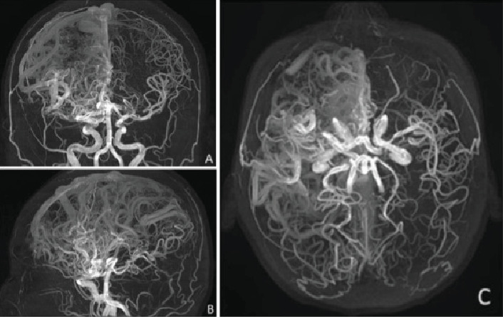 Epilepsy Secondary to a Giant AVM: A Case Report.