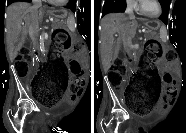 Colocaval Fistula: A Unique Case Report.
