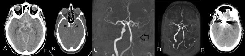 Ruptured anterior communicating artery aneurysm associated with internal carotid artery absence.