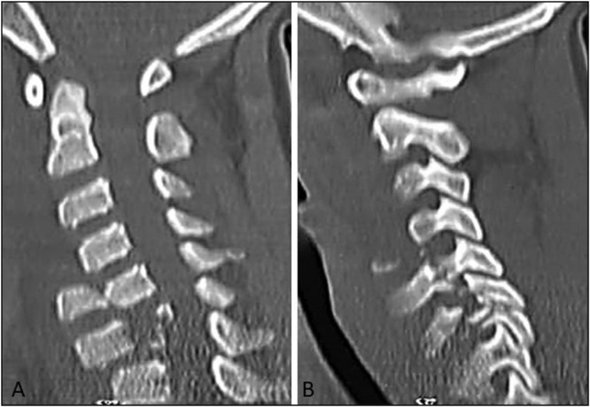 Successful Management of Traumatic Cervical Spondyloptosis with Incomplete Neurological Deficit in a Child: A Case Report.