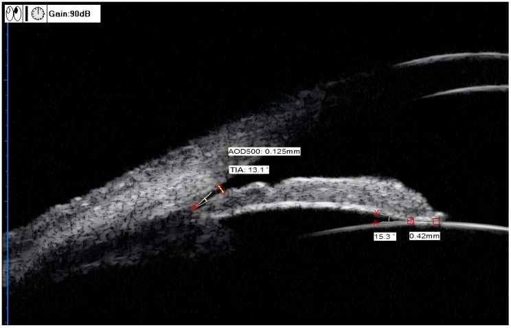 Ultrasound biomicroscopic imaging analysis of lens position and stability in acute and chronic angle-closure glaucoma.