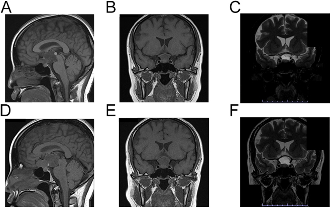 High-risk pregnancy complicated by craniopharyngioma: diagnosis in the context of visual impairment and tumor resection during pregnancy following IVF.