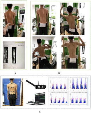 Immediate Effects of the Schroth Method on Spinal Curvature and Paravertebral Muscle Activation in Adolescent Idiopathic Scoliosis.