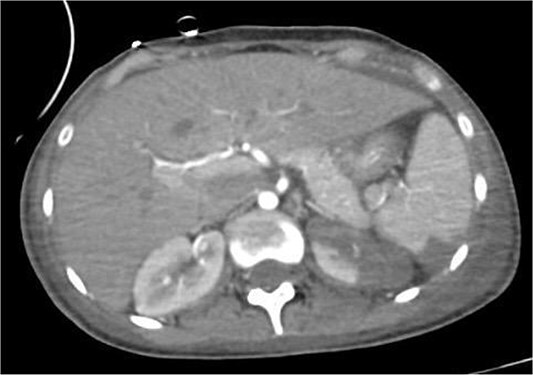 Ruptured intracranial Mycotic aneurysm following infective endocarditis in a young patient: a case report.