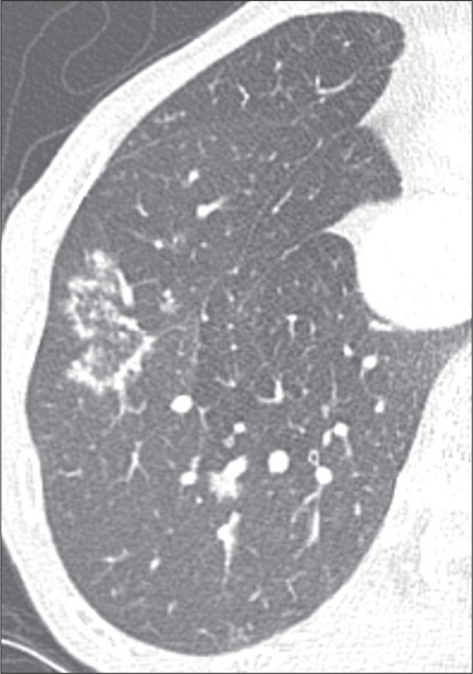 Reversed halo sign on chest computed tomography: a retrospective analysis of 286 cases.