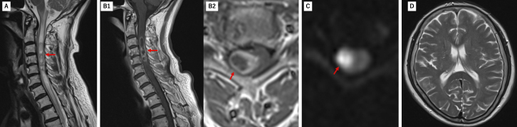 Rapidly Progressive Impaired Consciousness in Cervical Intramedullary Spinal Cord Abscess: A Case Report.
