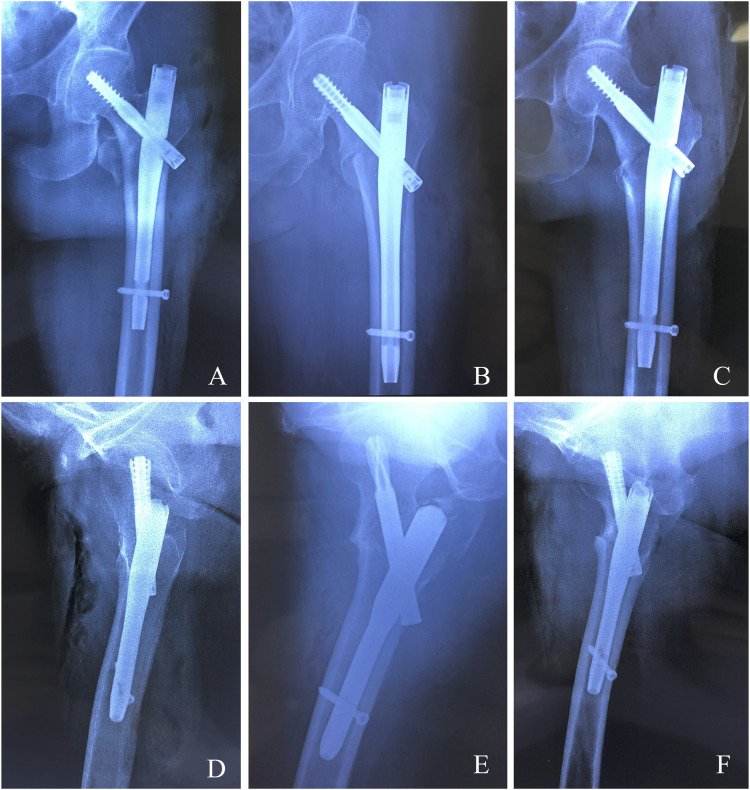 Incidence and Risk Factors for Femoral Malrotation Following Intramedullary Nailing of Trochanteric Fractures: A CT-Based Analysis.