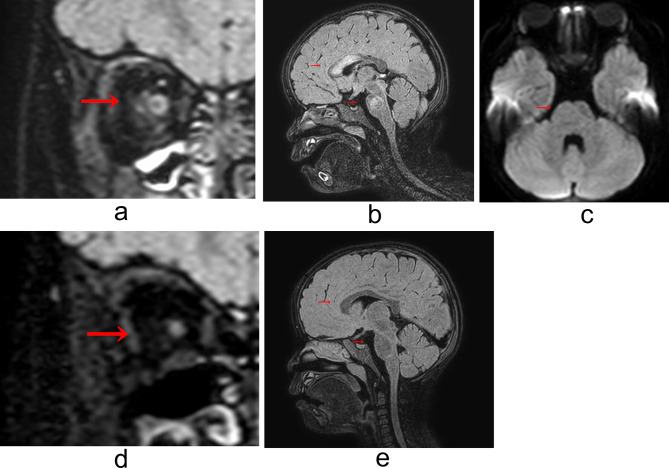 Efficacy of mycophenolate mofetil for the maintenance therapy of anti-AQP4 antibody-positive NMOSD complying with probable sjögren's disease in a 2-year-old girl: a case report.