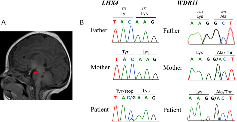 A case of congenital hypopituitarism harboring a nonsense variant in the <i>LHX4</i> gene.