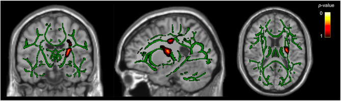 White matter tract differences in persistent post-traumatic headache, migraine, and healthy controls: a diffusion tensor imaging study.