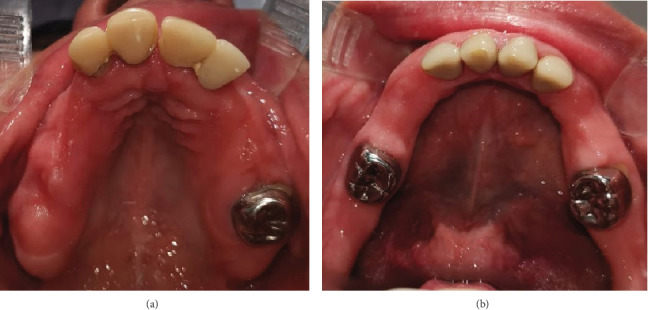 Generalized Odontodysplasia: A Case Report of the Oldest Reported Patient.