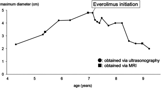 Successful Treatment of Growing Renal Angiomyolipomas With Low-Dose Everolimus in a School-Aged Child With Tuberous Sclerosis Complex.