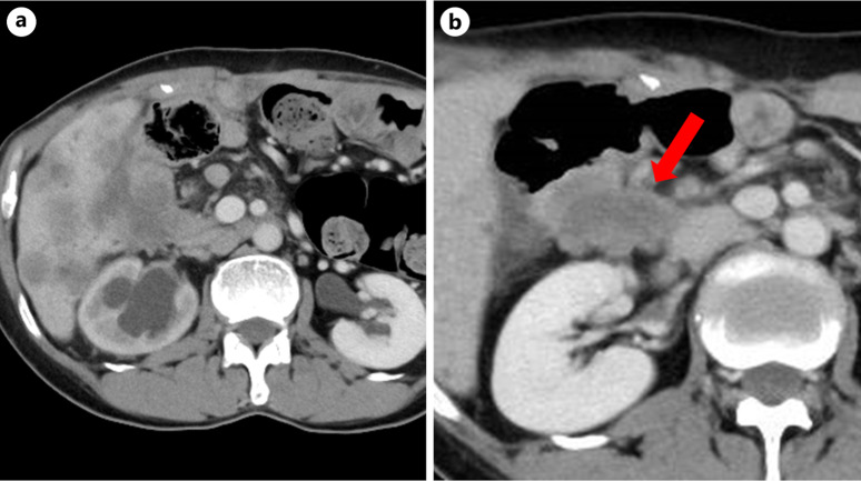 Small Duodenal Adenocarcinoma with Peritoneal Dissemination Mimicking Duodenal Brunner's Gland Hyperplasia.