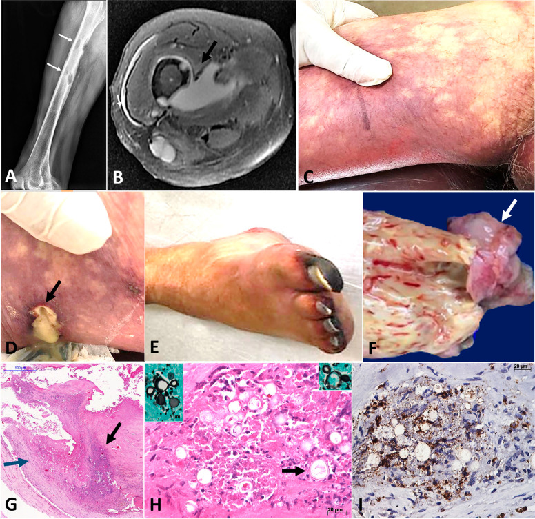 Osteomyelitis and aortic arteritis with thrombosis as primary manifestations of severe paracoccidioidomycosis: a case report.