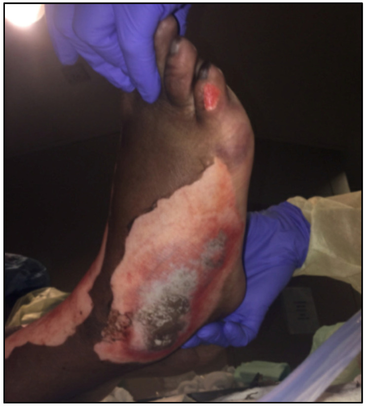 Exploring Disparities in Pavement Burns: A Comparative Analysis of Housed and Unhoused Burn Patients.
