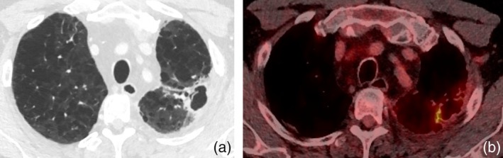 Silicosis Mimicking Lung Malignancy: A Case Series.