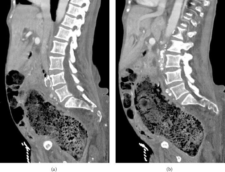 Colocaval Fistula: A Unique Case Report.