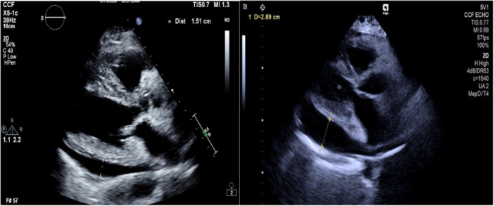 Pericardial Effusion and Prostacyclin Analog Toxicity After Initiation of Sotatercept.