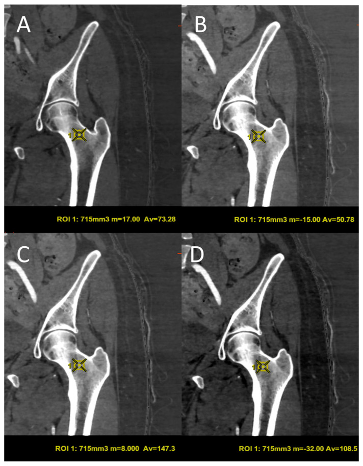 Bone Mineral Density (BMD) Assessment Using Dual-Energy CT with Different Base Material Pairs (BMPs).
