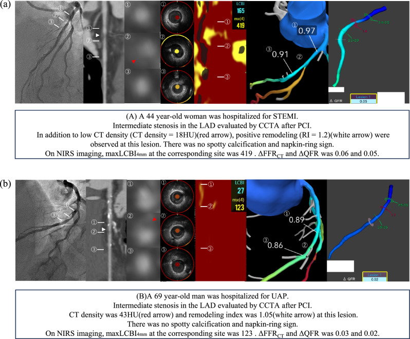 Incremental value of physiological indices to predict high-risk plaques detected by NIRS-IVUS.
