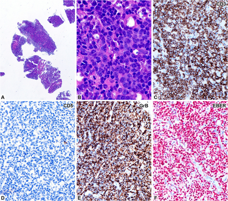 Effusion cytology of EBV-associated lymphoma: a concise review.