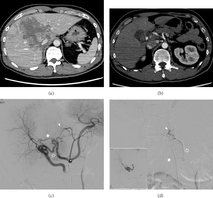 Efficacy of Transcatheter Arterial Embolization for Hemorrhage Control in Traumatic Hepatic Injury With Celiac Axis Stenosis.