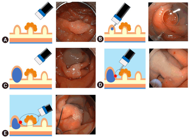 Utility of underwater endoscopic mucosal resection combined with a protruding anchor by saline injection for superficial non-ampullary duodenal tumors: a retrospective study in Japan.