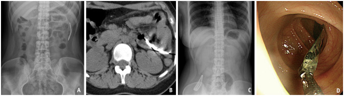 Foreign Body Ingestion: Radiologic Evaluation, Findings, and Management.