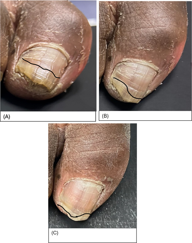 Efficacy of Topical Antifungal Nail Solution Versus Topical Placebo Solution for the Treatment of Pedal Onychomycosis: A Randomized Controlled Trial.