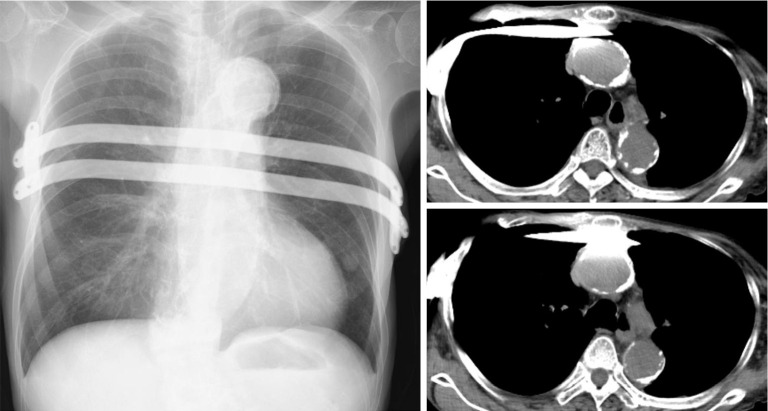 Application of the Nuss procedure for flail chest following cardiopulmonary resuscitation: a case report.
