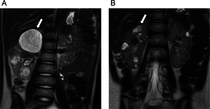 Successful Treatment of Growing Renal Angiomyolipomas With Low-Dose Everolimus in a School-Aged Child With Tuberous Sclerosis Complex.
